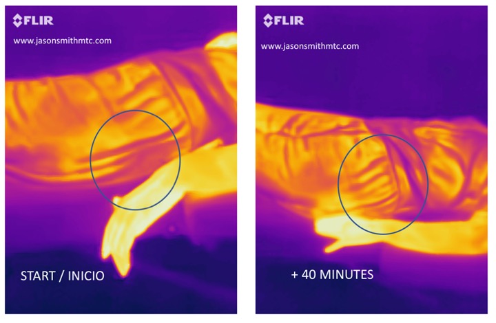 ¿Como reduce la acupuntura el dolor muscular?